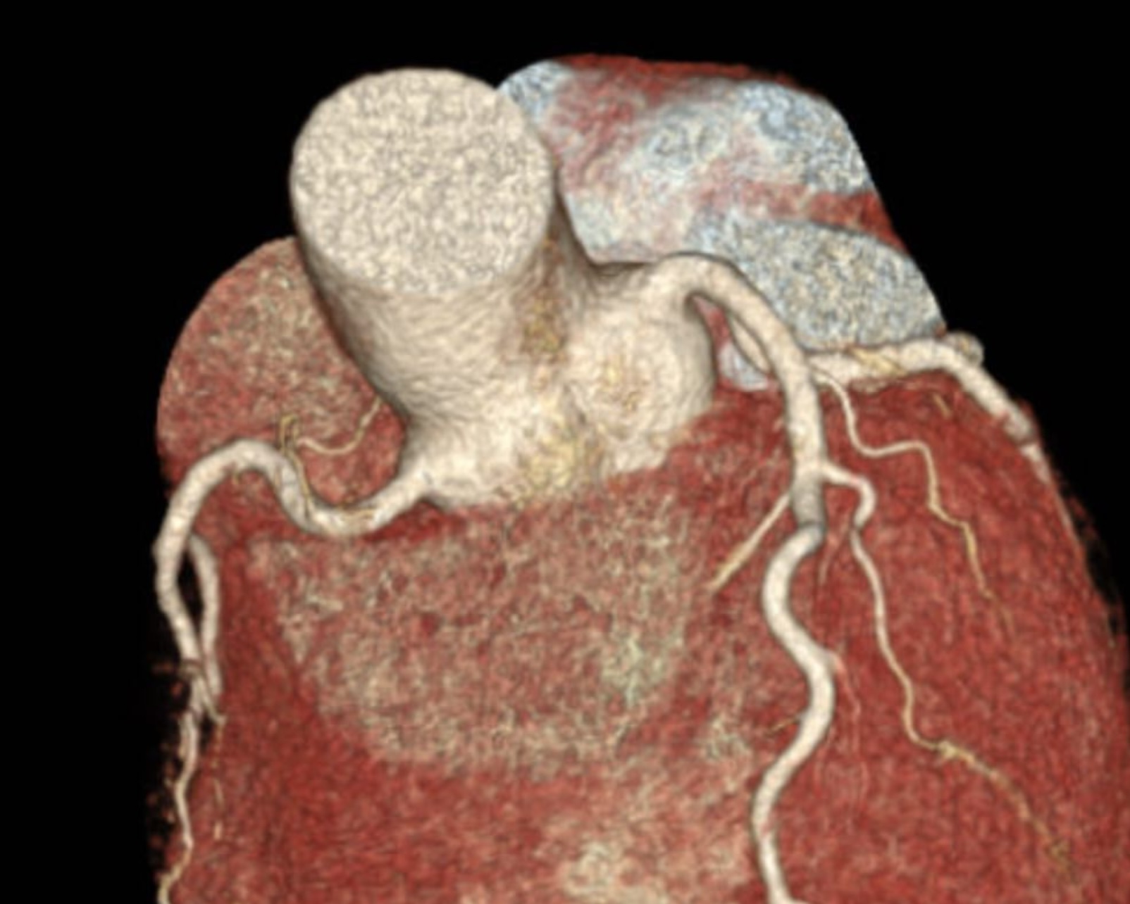 CT Coronary Angiogram Course Level 1 – Informed Medics
