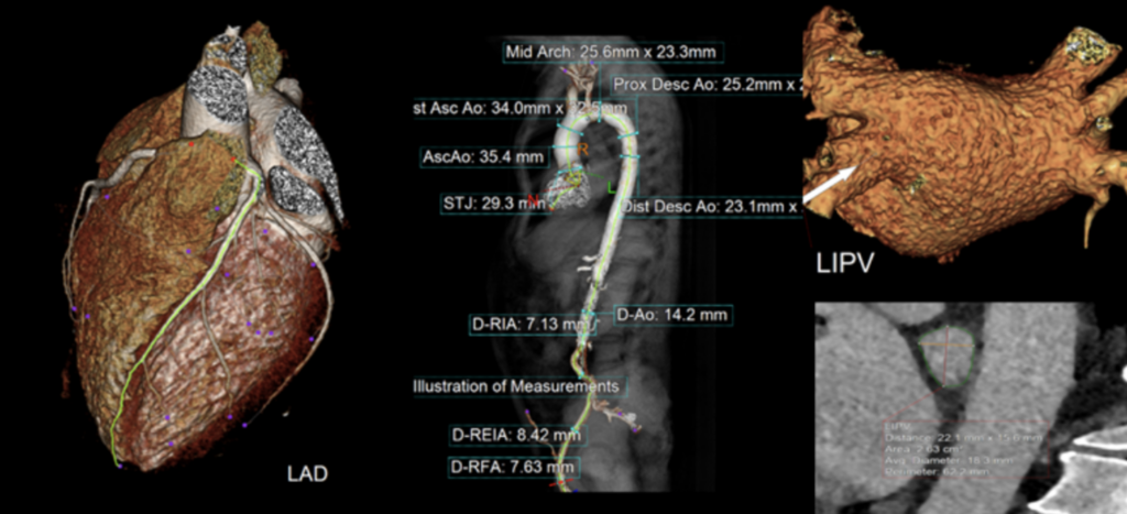 CT Coronary Angiogram Level 2 Accreditation Course – Informed Medics